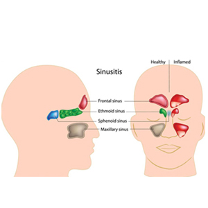 Sinusitis surgery