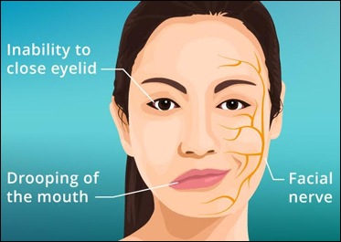 Therapy For Facial Palsy, Mumbai