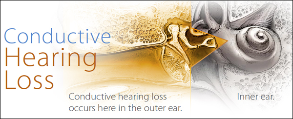Conductive Hearing Loss