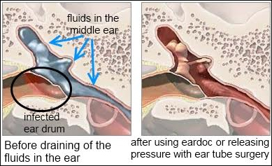 Ear Infections