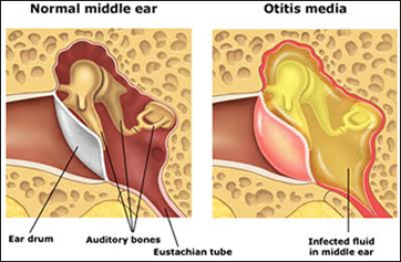 Ear Infections