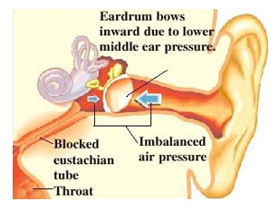 Eustachian Tube Problems, Eustachian Tube Problems Treatment, Kalyan, Thane, Mumbai, India
