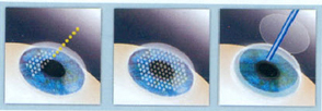 Femto Lasik