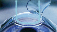 femto lasik