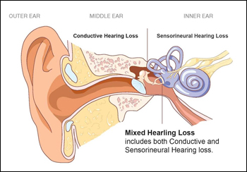 Conductive Hearing Loss