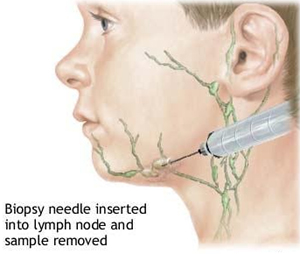 Lymphnode Biopsy