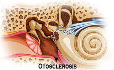 otosclerosis