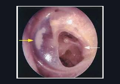 perforated ear drum