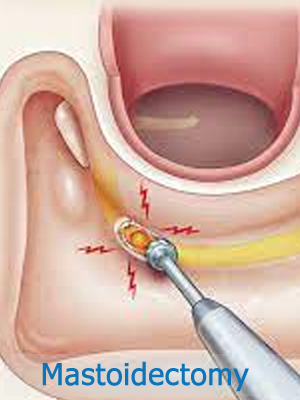 Mastoidectomy