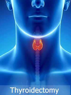 Thyroidectomy