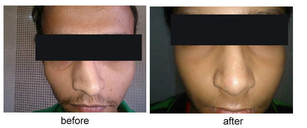 rhinoplasty