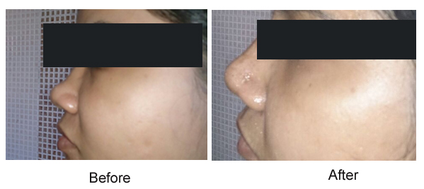 rhinoplasty