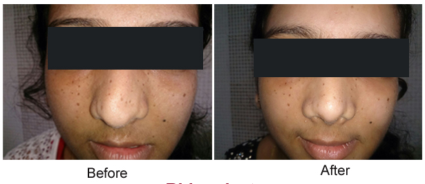 rhinoplasty