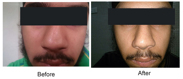 rhinoplasty