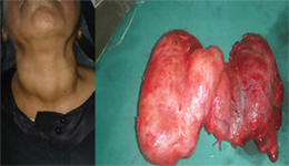Thyroid