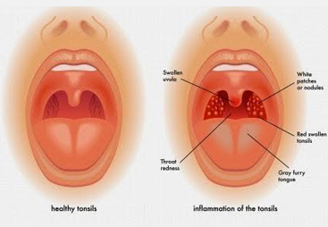 tonsilectomy