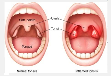 tonsilectomy
