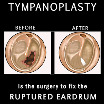 Tympanoplasty